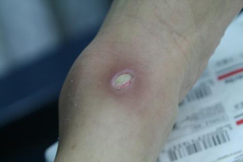 soigner une plaie infectee au pied soigner une plaie infectee au pied